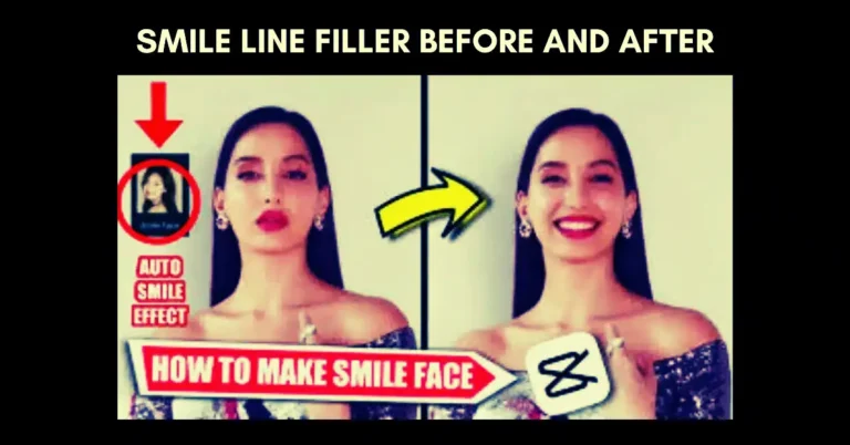 Smile Line Filler Before and After