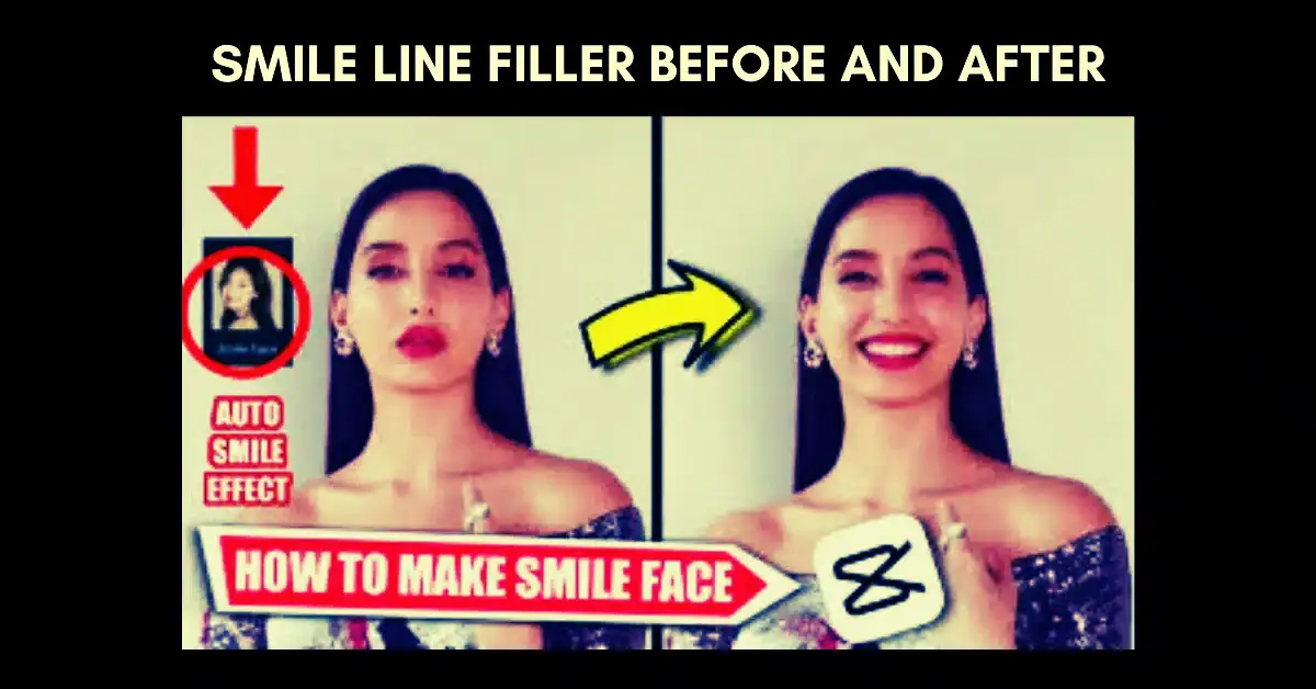 Smile Line Filler Before and After